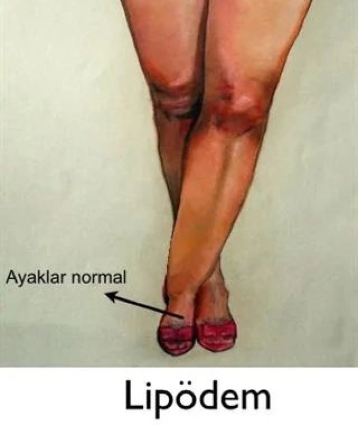 Menopozda V&uuml;cut Tipiniz Değişiyorsa Dikkat: Obezite Sanılan "Lip&ouml;dem" Tehlikesi