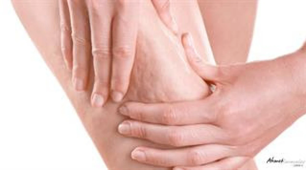 Sel&uuml;lit Sadece Estetik Bir Sorun mu? Uzmanlar Metabolik Etkilere Dikkat &Ccedil;ekiyor